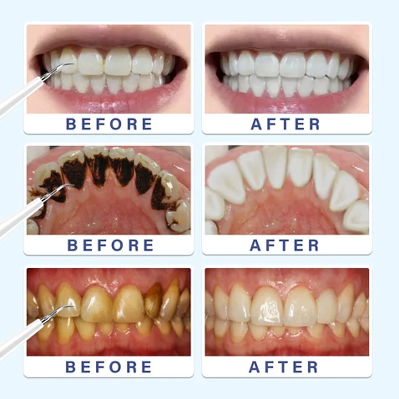 Electric Toothbrush Dental Calculus Remover Kit - Image 6
