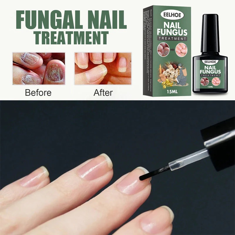 Fungal Nail Treatment - Image 10