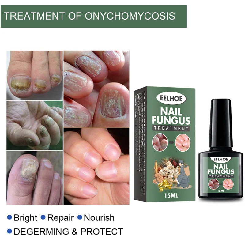Fungal Nail Treatment - Image 2