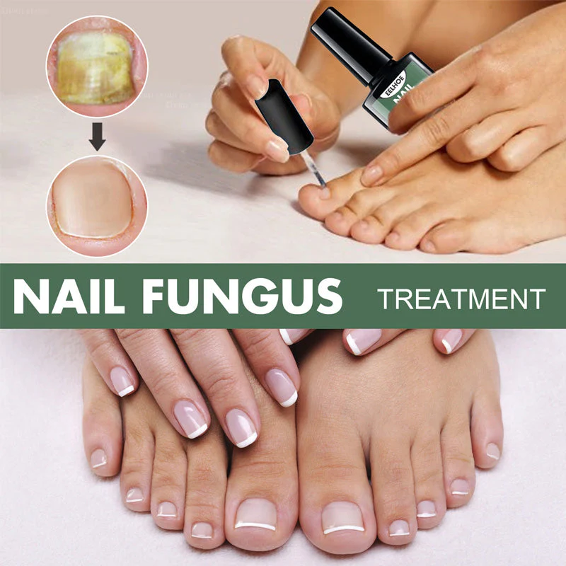 Fungal Nail Treatment - Image 3