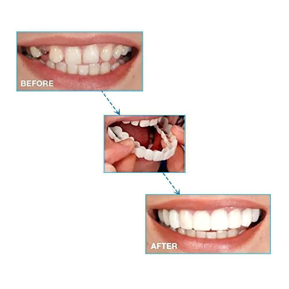 1 SET OF DIAMOND SMILE VENEERS (TOP & BOTTOM TEETH) - Image 3