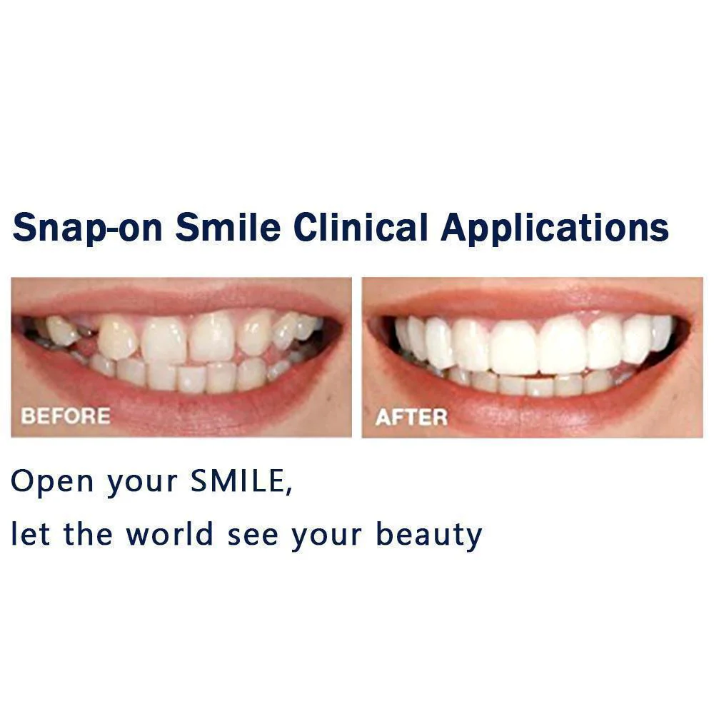 1 SET OF DIAMOND SMILE VENEERS (TOP & BOTTOM TEETH) - Image 4