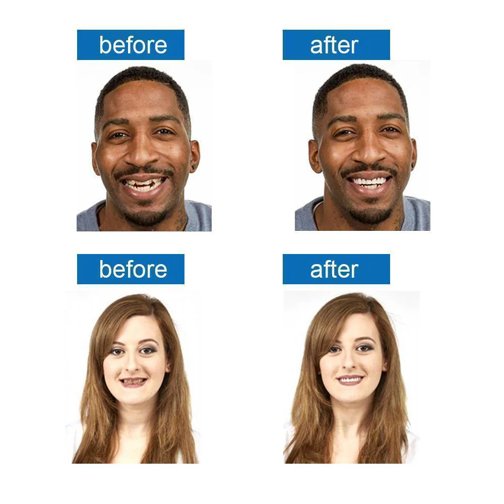 1 SET OF DIAMOND SMILE VENEERS (TOP & BOTTOM TEETH) - Image 8