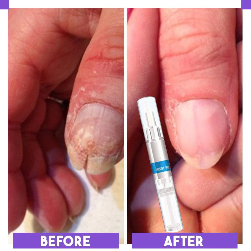 Nail Restoration Pen - Image 10