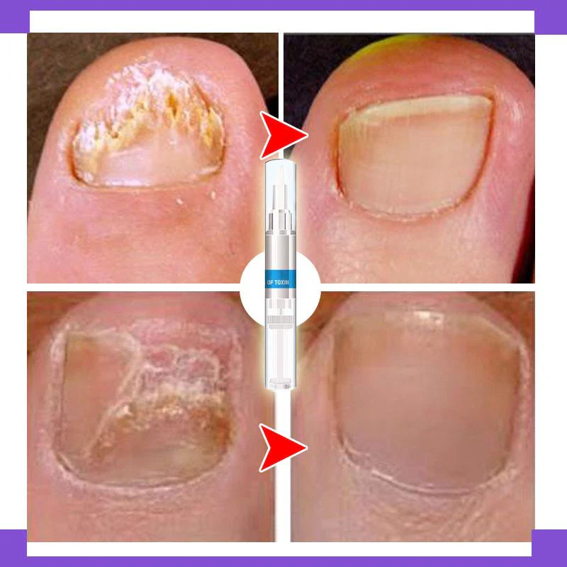 Nail Restoration Pen - Image 11