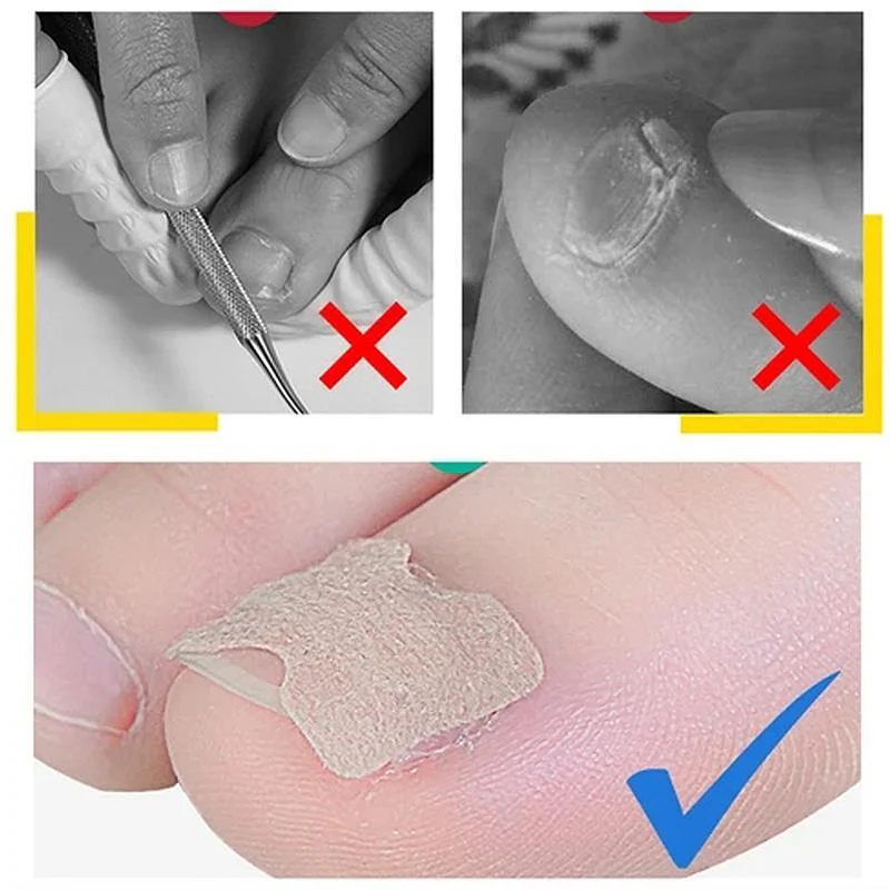 Non-Glue Toenail Patch - Image 4
